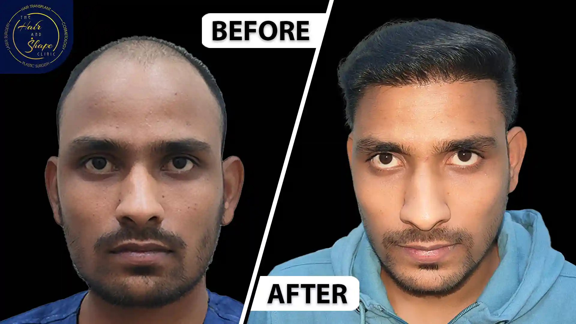 Hair Transplant result10